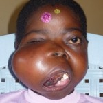 She Will be Beautiful Again Jacinta Before Treatment